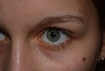 Le grain de beauté qui saigne : que faire ?